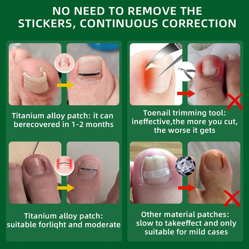 Kit De Tratamento E Remoção De Unhas Encravadas Fuzzycare Ti