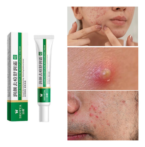 03 Creme Tratamento Eficaz Para Acne E Espinhas Oleosa Dia/noite