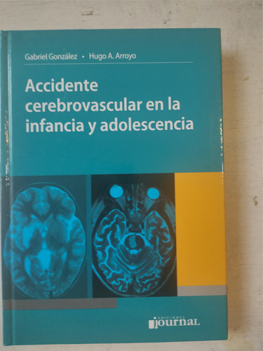 Accidente Cerebrovascular En La Infancia Y Adolescencia