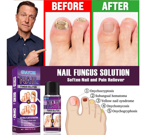 Solução De Reparo De Unhas Cinza Esmalte Para Unhas Para Pés