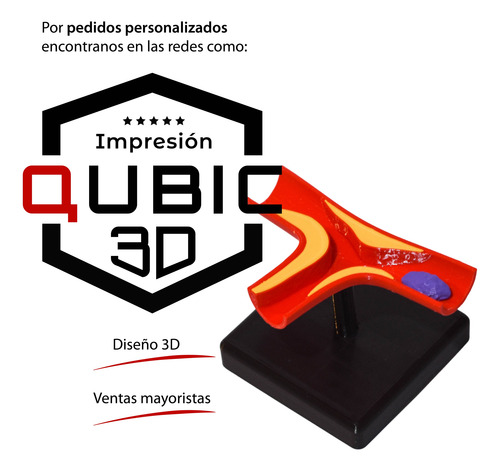 Maqueta Arteria Con Ateroma Semi Oclusivo - Medicina 3d