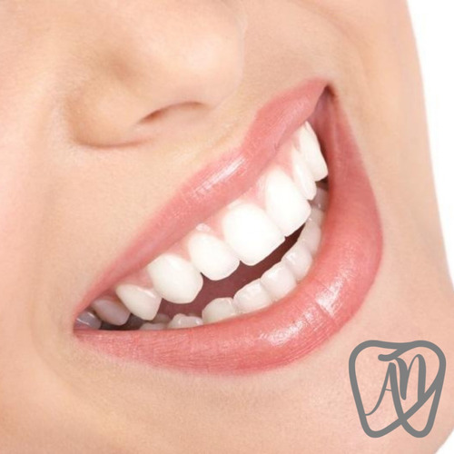 Imagen 1 de 4 de Limpieza Dental Con Ultrasonido Y Aeropulido + Fluor