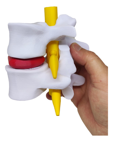 Modelo Anatômico Hérnia Disco Coluna Vertebral 3d