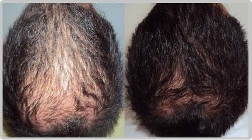 Hair Loss Control Idraet Shampoo Neutro Engrosador Anticaida