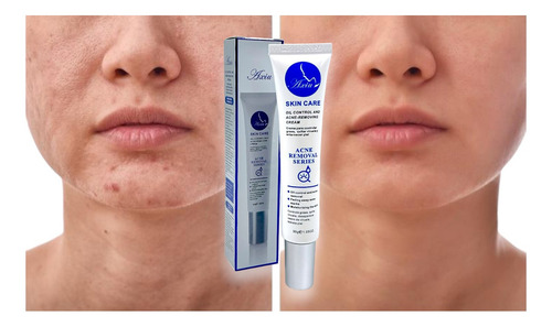 Crema Anti Acné Elimina Granos Espinillas Tratamiento 30g Momento De Aplicación Noche Tipo De Piel Mixta