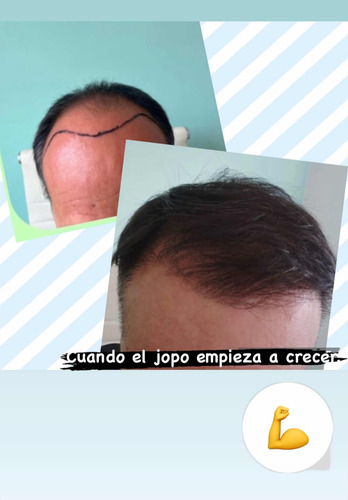 Implante Capilar Pelo Por Pelo Alta Densidad