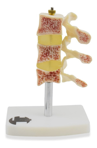 Zeigen Modelo De Osteoporosis  3 Vértebras Lumbares Premium