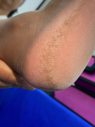 Removedor Hiperqueratosis Plantar Luxury Tratamiento