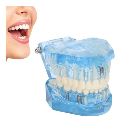 Youpin Dientes Dentales Modelo Acrílico Azul Transparente