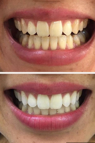 Blanqueamiento Dental - Realizado Por Odontólogo- 