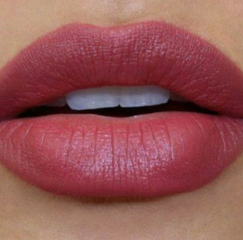 Imagen 1 de 3 de Relleno De Labios Con Acido Hialurónico Reticulado