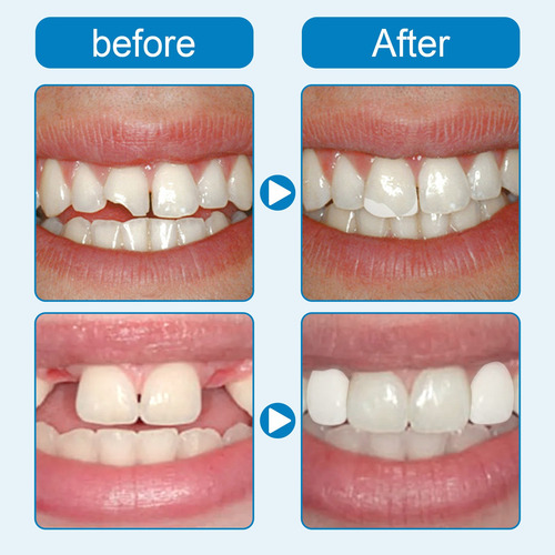 Reparo Dentário: Consertando A Substituição De Dentes Perdid