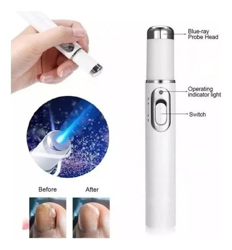 Lápiz Láser Para Hongos En Uñas, 2 Bolígrafos, Luz Azul