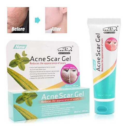 Imagen 4 de 5 de Crema Gel Contra Acne,espinillas,repara, Inflamacion Facial