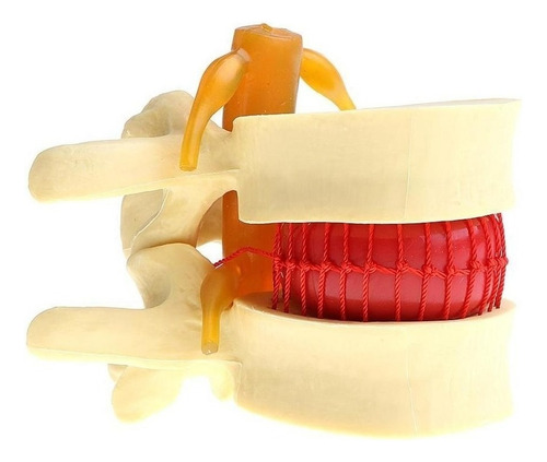 . 2x Modelo De Hernia De Disco Lumbar De La Columna