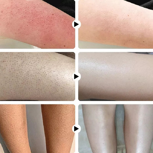 . Crema De Tratamiento Reparador De Queratosis Pilaris Que
