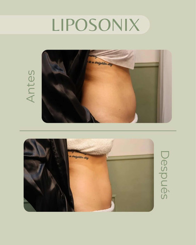 Hifu 22d Max Y Liposonix