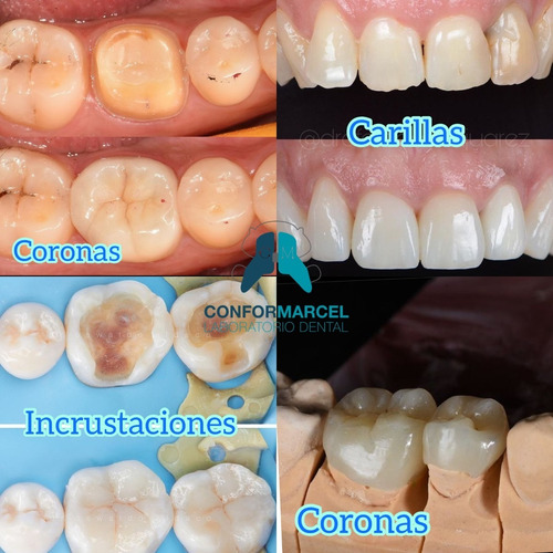 Imagen 2 de 10 de Prótesis Dentales Removibles Y Fijas