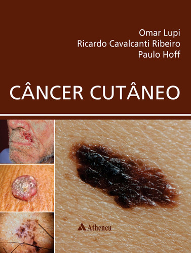 Câncer Cutâneo, de Lupi, Omar. Editora Atheneu Ltda, capa dura em português, 2018