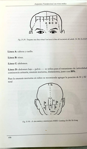 Acupuntura Neurofuncional Una Tecnica Medica. (Usado)