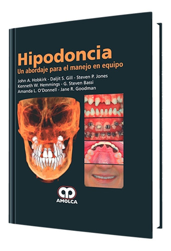 Hipodoncia. Un Abordaje Para El Manejo En Equipo.