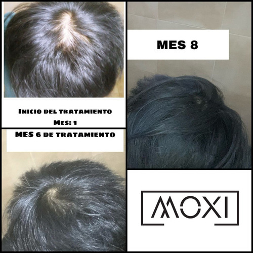 Loción Minoxi 5 Crecimiento Del Cabello