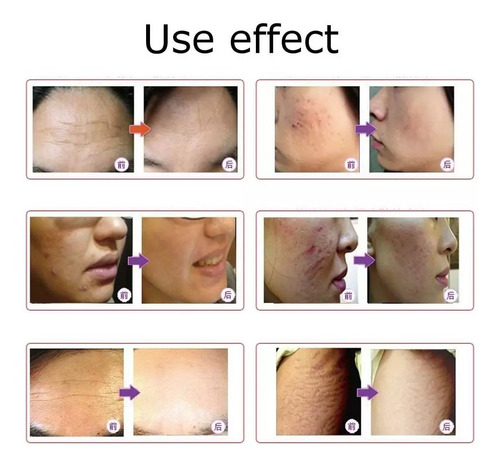 Imagen 5 de 5 de Dr Pen X5 Morado Dermapen Ultima Tecnologia Inalambrico!!!