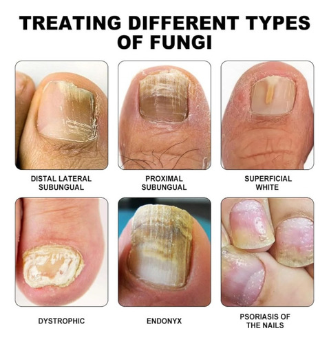 Dispositivo De Terapia Láser Para Hongos En Las Uñas