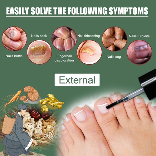 Alivia Uñas Enterradas Elimina Onicomicosis Nail Fungus