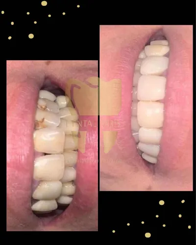 Carilla Dental En Resina (precio Por Unidad)