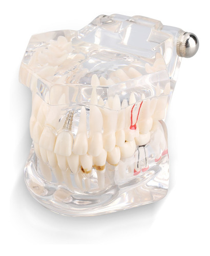 Modelo Dental: Estudio De Enseñanza De Enfermedades, Tipodon