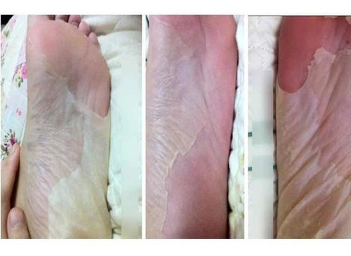 Eliminador De Callos Peeling Para Pies