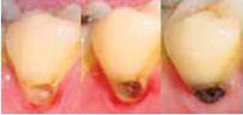 Imagen 5 de 7 de Fagamín Fluoruro Diamino Plata Dental 5ml Santiago