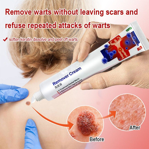 6×pomada Para Eliminar Las Verrugas Del Herpes Genital
