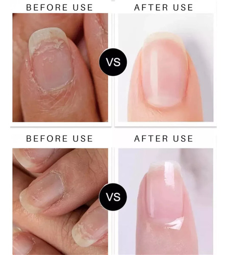 Suero Reparacion Uñas Ataca Hongos Onicomicosis Importado Neutra