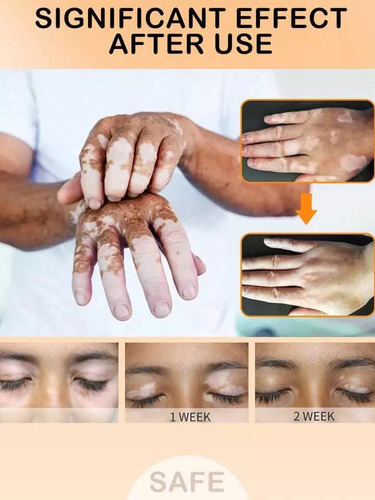 Crema Tratamiento Profesional Para Eliminar El Vitiligo Original
