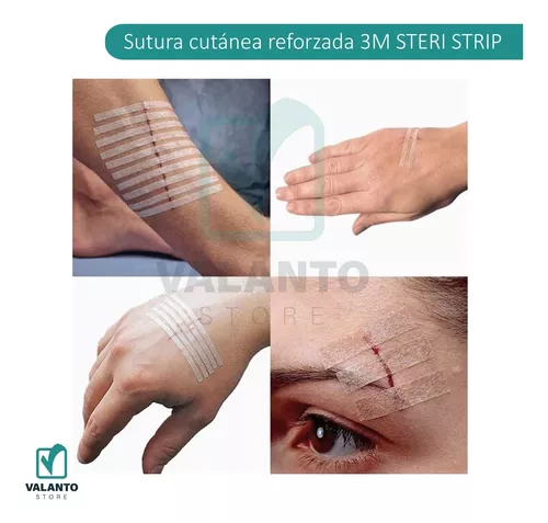 SteriStrip, los puntos de sutura adhesivos