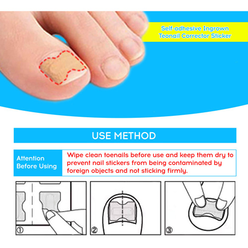 72pcs Jelly Glue Self-adhesive Ingrown Teonail Corrector