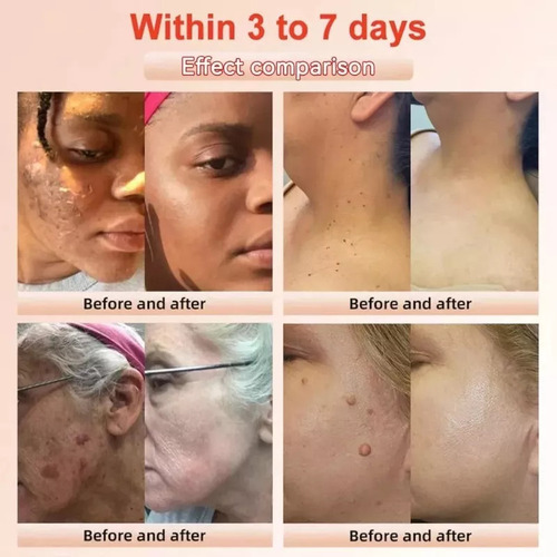 El Gel Exfoliante Ouhoe Limpia Suavemente La Piel, Reduce Lo