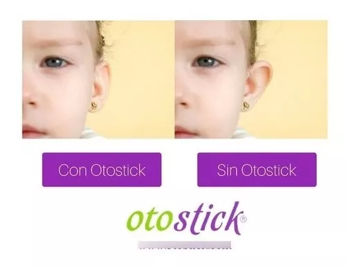Otostick Bebé, Correctores estéticos para orejas separadas, Contiene 8  correctores + 1 gorro