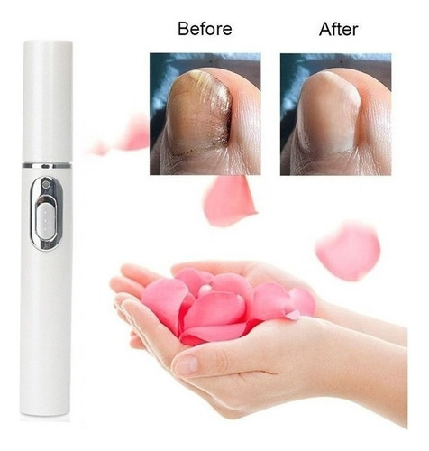4×pluma Hongos Uñas Calientes Pluma Láser Luz Azul