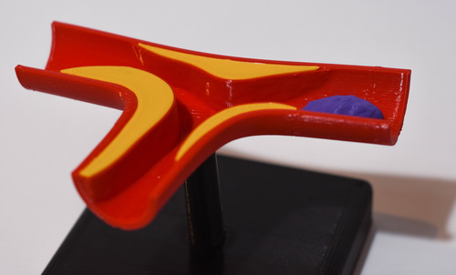 Maqueta Arteria Con Ateroma Semi Oclusivo - Medicina 3d