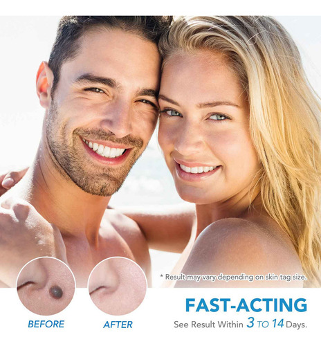 Micro Skin Tag Remover Kit De Eliminación De Etiquetas