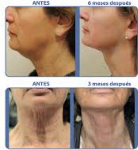 Imagen 4 de 4 de Hifu 8d Facial