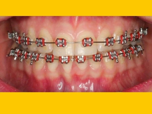 Ortodoncia Con Brackets Zafiro