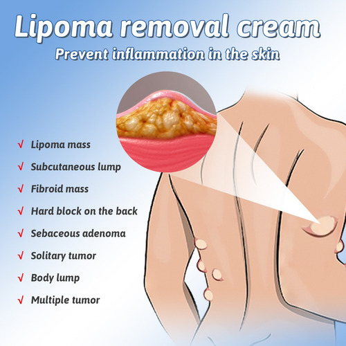 Crema Eliminadora De Tumores Para Mejorar Los Nódulos De Gra