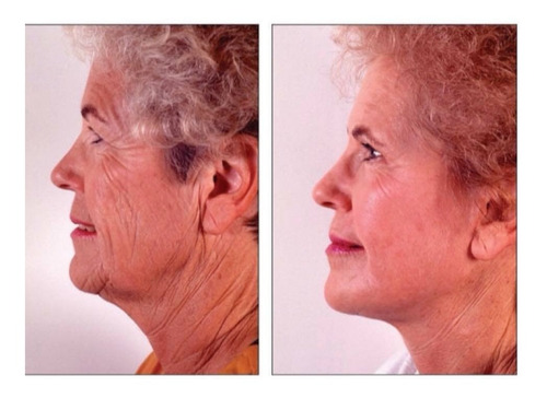 Skindulgence Rejuvenecimiento Facial Sin Cirugía 30 Min Tipo De Piel Todo Tipo De Piel