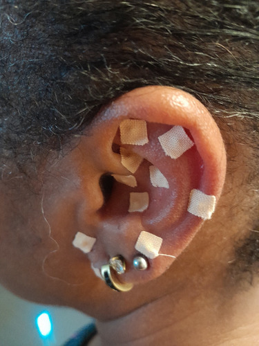 Auriculoterapia