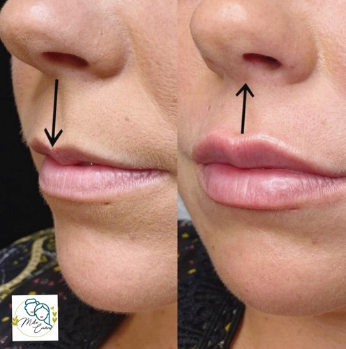 Imagen 5 de 5 de Aumento Y Perfilacion De Labios