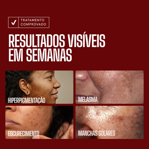 Sérum Facial Melasma E Acne Com Ácido Tranexâmico Acneica Noite